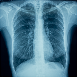 X-Ray